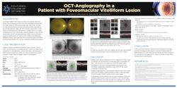 OCT-Angiography in a Patient with Foveomacular Vitelliform Lesion